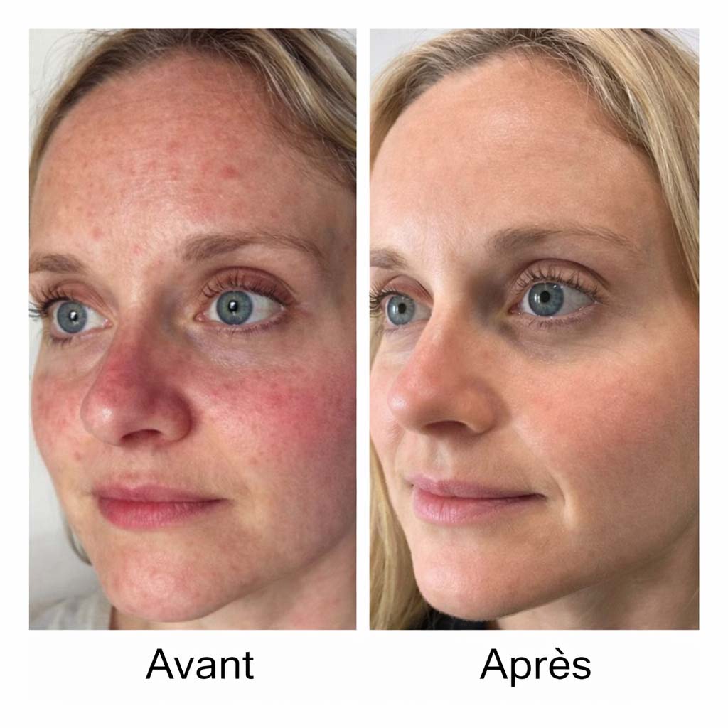 Après